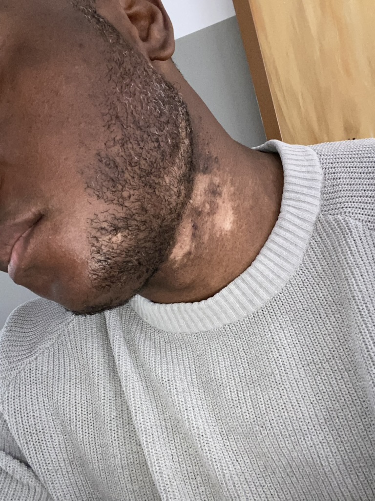 The actual first patch on Kabir's skin, photographed before his vitiligo diagnosis.